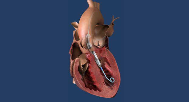 Impella ECP pump in heart illustration