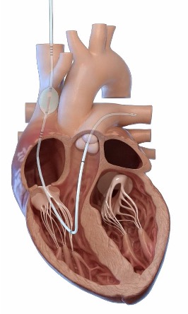 The preCARDIA system is placed in the heart to intermittently occlude the superior vena cava